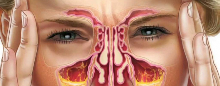 Симптомы и лечение гайморита